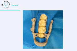 short and long distal extension clamps